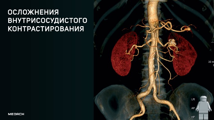 Осложнения внутрисосудистого контрастирования