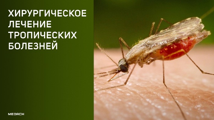 Хирургическое лечение тропических болезней