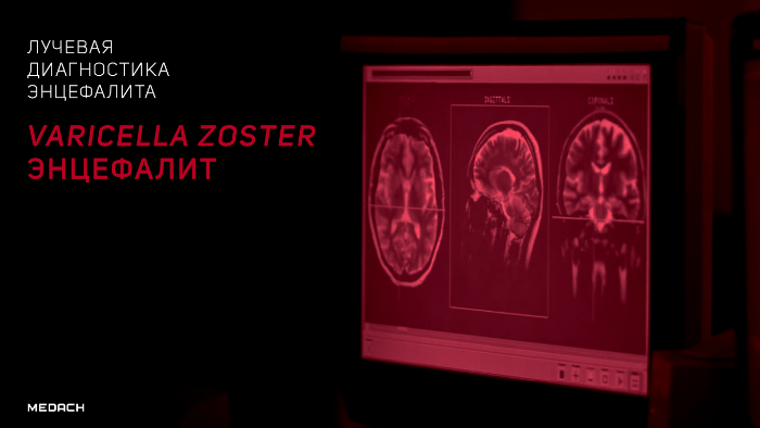 Varicella Zoster энцефалит