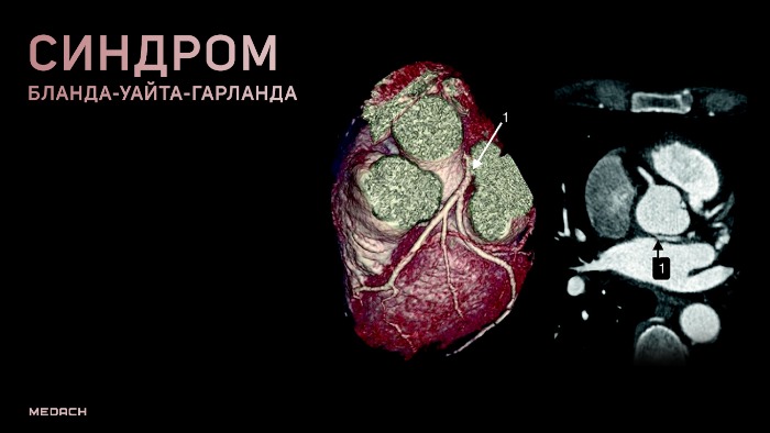 Cиндром Бланда-Уайта-Гарланда