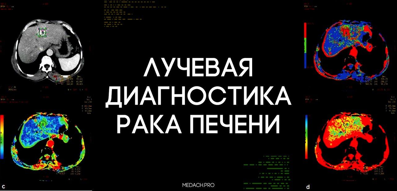 Лучевая диагностика гепатоцеллюлярного рака