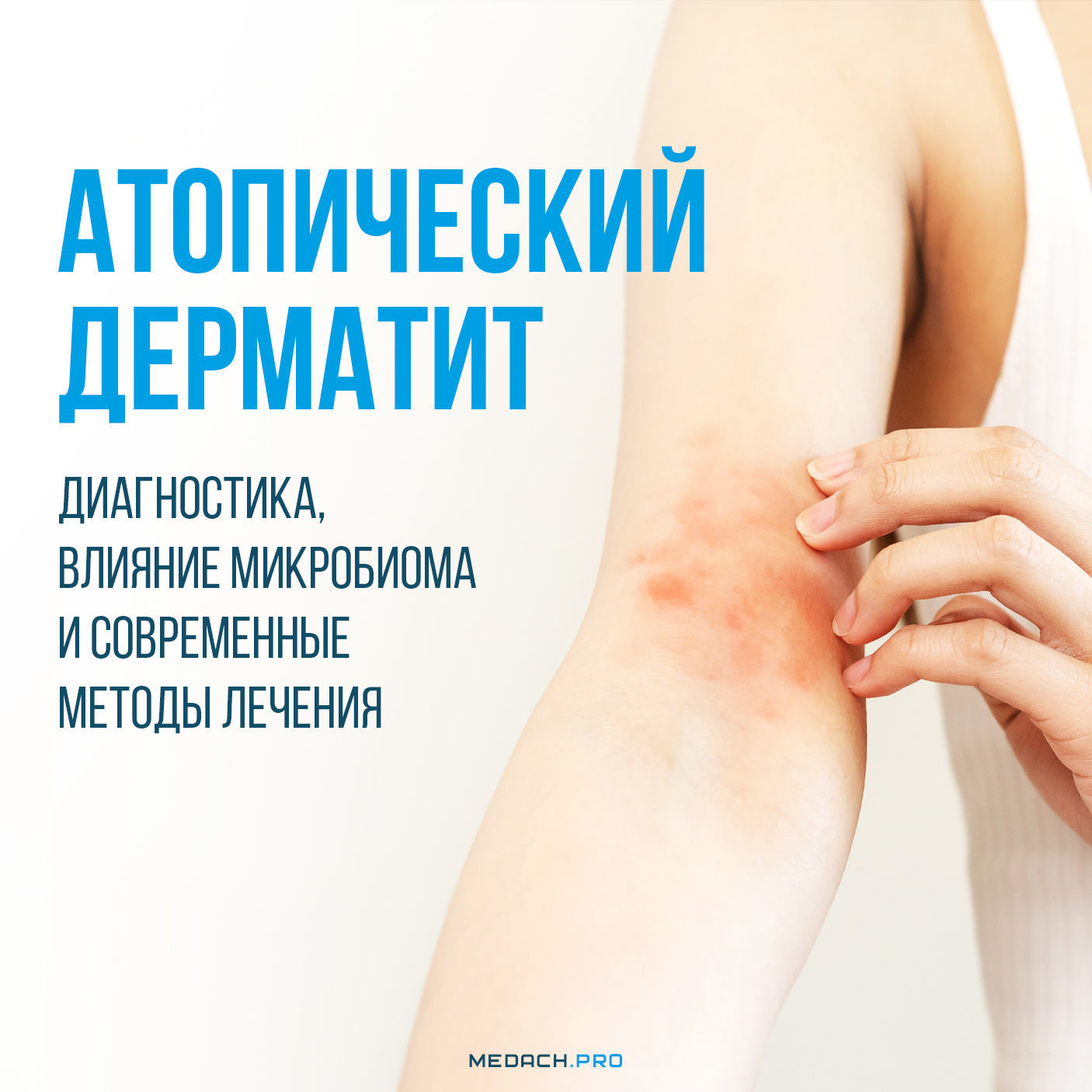 Атопический дерматит: диагностика, влияние микробиома, современные методы лечения