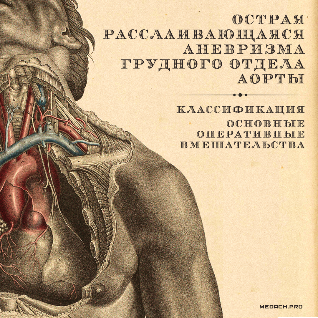 Расслаивающая аневризма аорты
