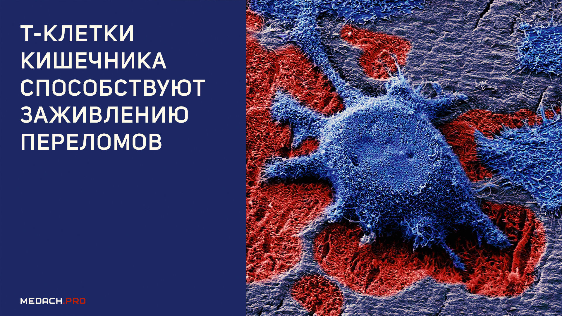 Т-клетки кишечника способствуют заживлению переломов