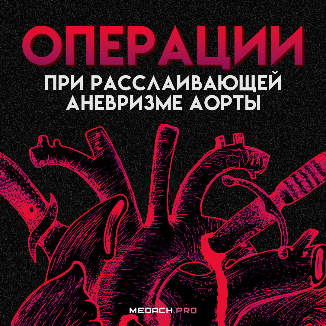 Операции при расслаивающей аневризме аорты