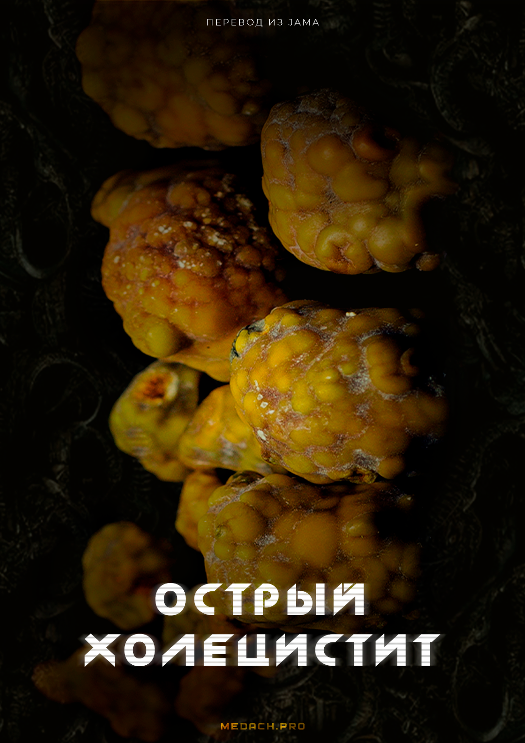 Острый холецистит