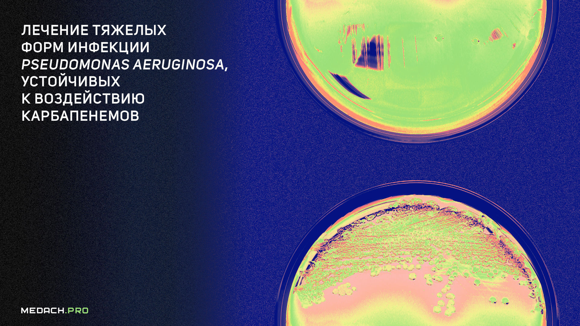 Лечение тяжелых форм инфекции Pseudomonas aeruginosa, устойчивых к воздействию карбапенемов